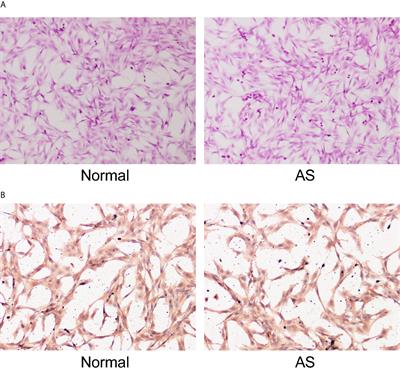 microRNA-214-3p Suppresses Ankylosing Spondylitis Fibroblast Osteogenesis via BMP–TGFβ Axis and BMP2